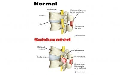 La subluxation